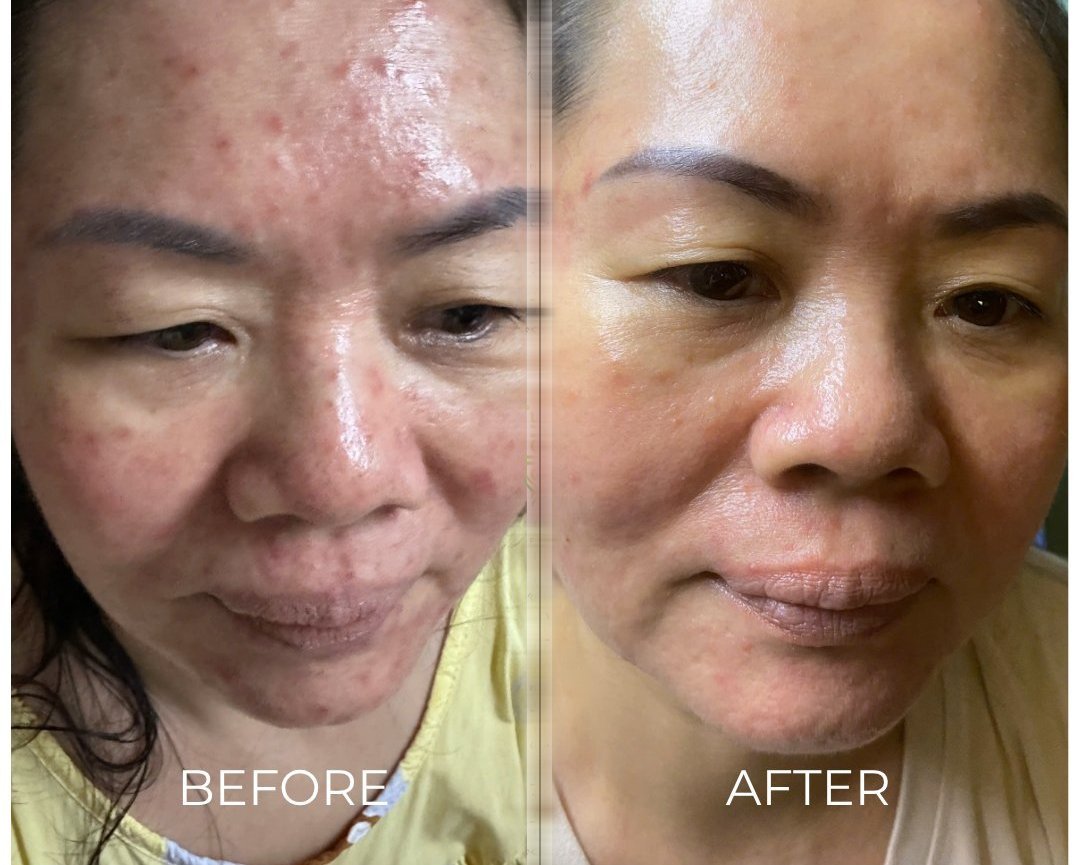 Chị Hà 48 tuổi - Hành trình cải thiện mụn viêm