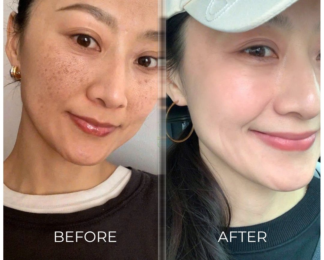 Chị Lan 42 tuổi - Nám sạm dày đặc