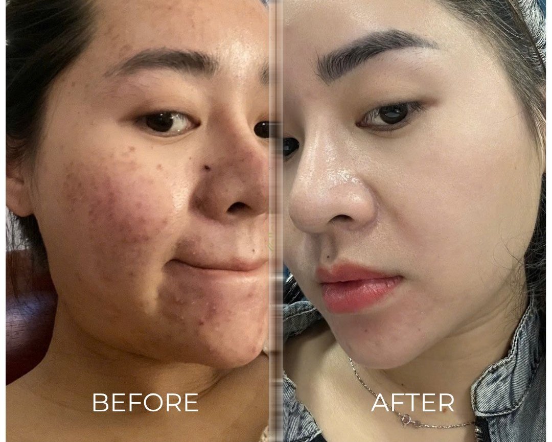 Em My 29 tuổi - Mụn bọc nội tiết