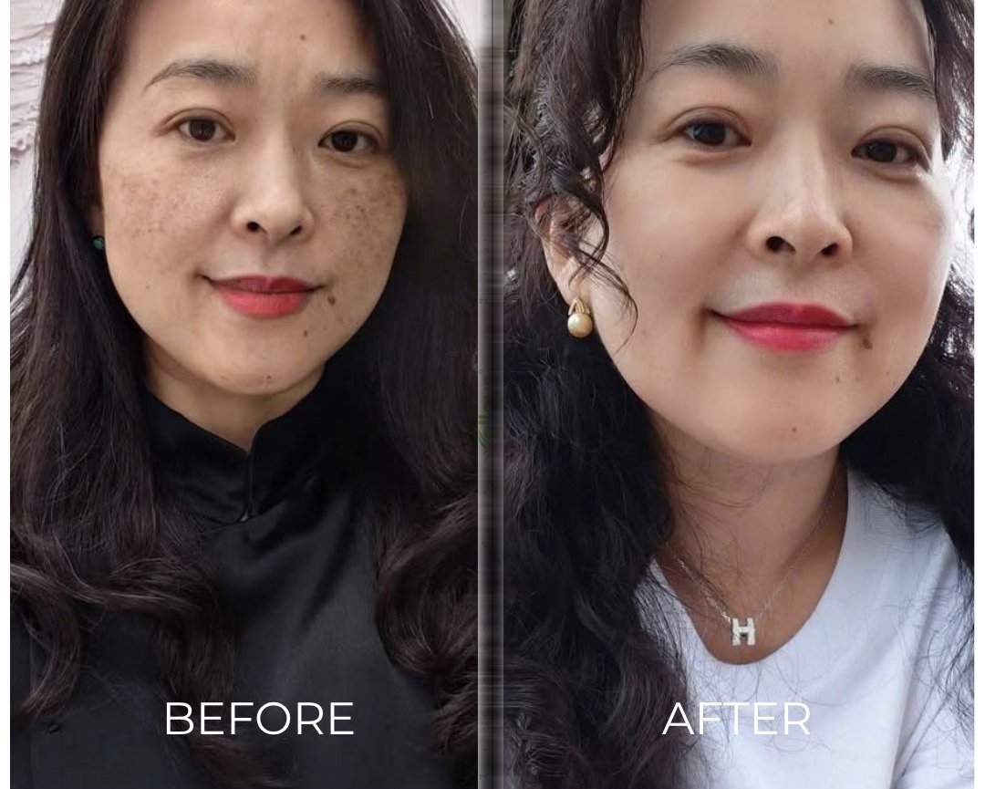 Chị Hương 45 tuổi - Nám tiền mãn kinh