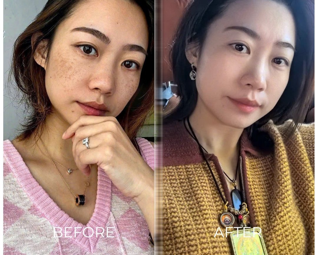 Em Trang 28 tuổi - Tàn nhang và da khô